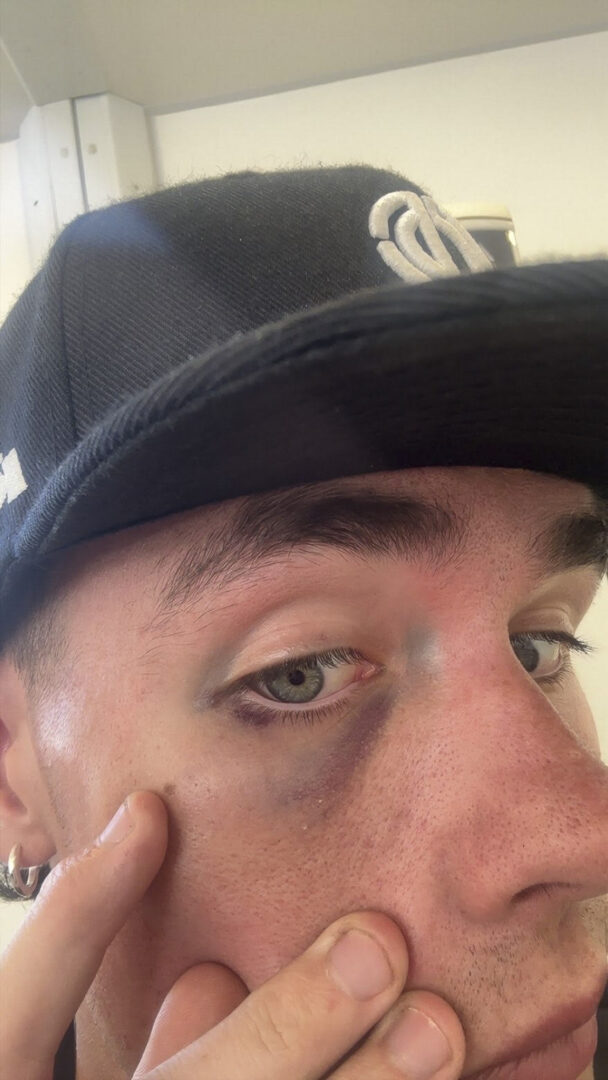 Cormac Buchanan Brazil injury after big highside