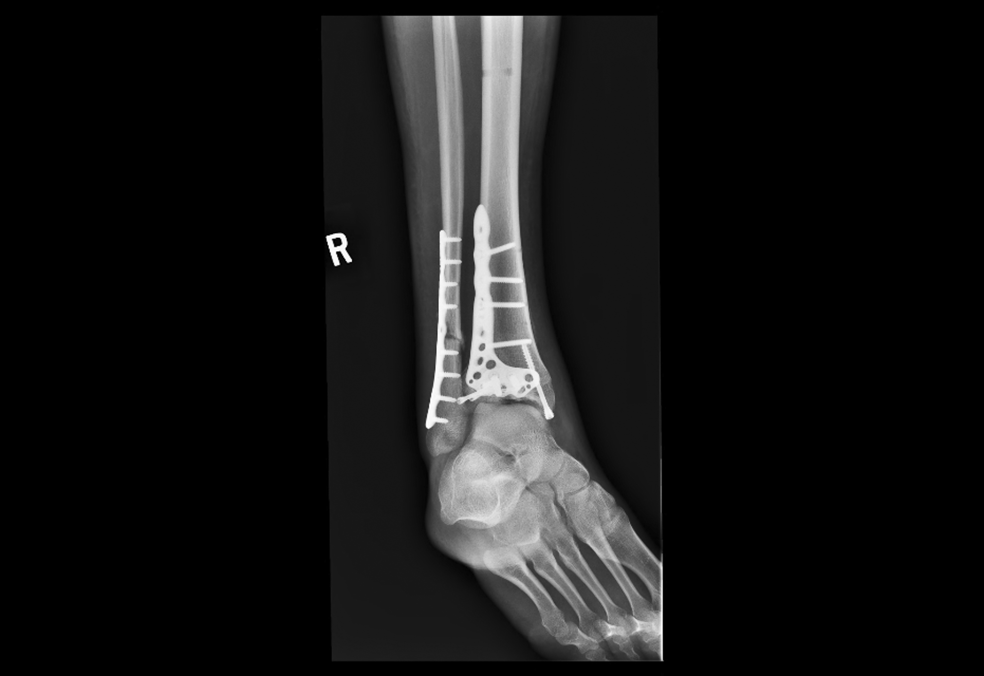 X-ray of Cormac Buchanan’s right ankle showing surgical plates and screws.